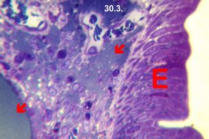 Whipple diseaselipid ,alabsorption - arrows(semithin section) Whipple diseaselipid ,alabsorption - arrows(semithin section)